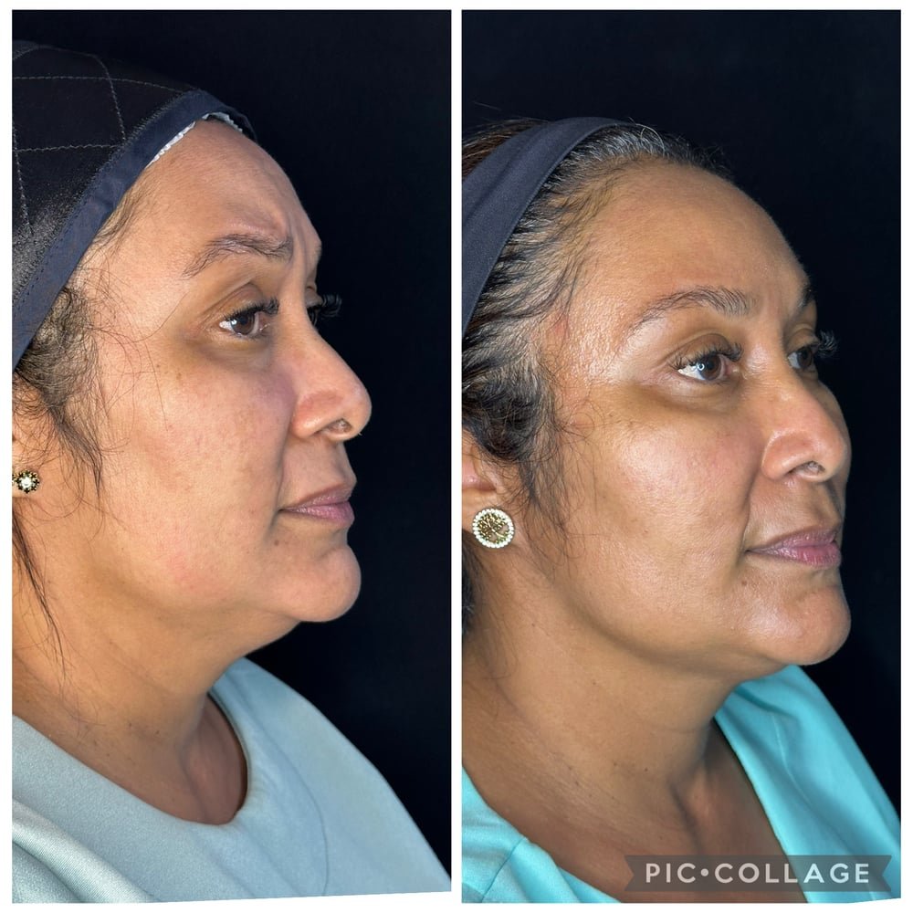 Fotos de antes e depois de fios de PDO de tração, preenchimento em pontos de sustentação e botox realizados pela Dra. Marina Barreto