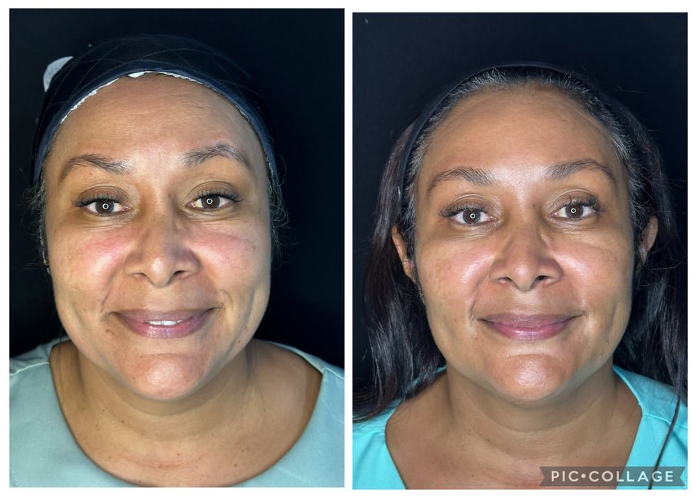 Fotos de antes e depois de fios de PDO de tração, preenchimento em pontos de sustentação e botox realizados pela Dra. Marina Barreto