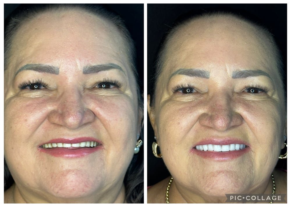 Fotos de antes e depois de botox e reabilitação oral com próteses dentárias realizados pela Dra. Marina Barreto